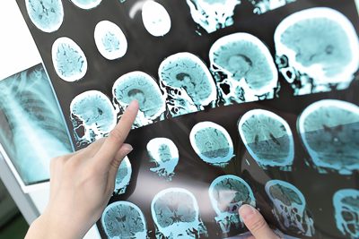Marijuana's Effect on the Brain - brain scan - Fair Oaks Recovery Center